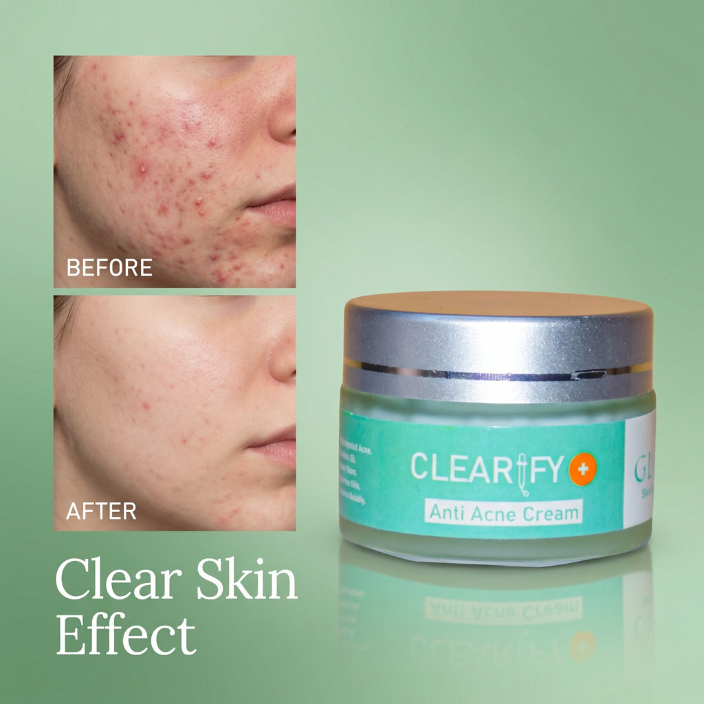 GLAMI Clearify+ Anti Acne Cream – Oil Control & Clear Skin Formula